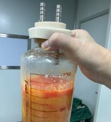 池州水动力吸脂手术要做多久？